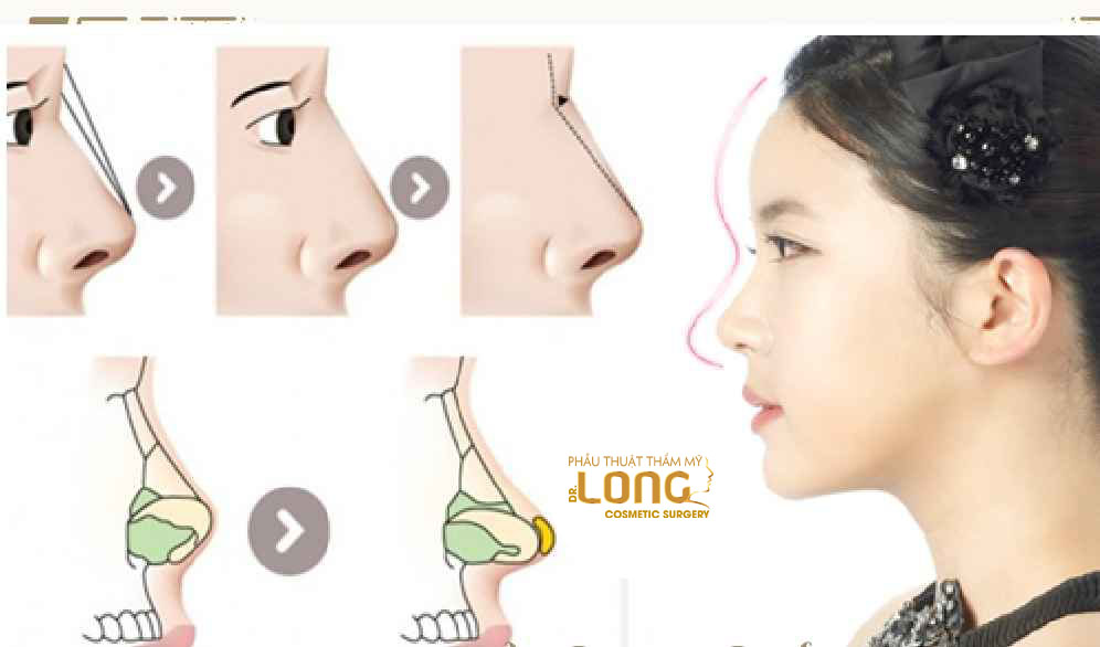 最新鼻整形技術(shù)重塑自信，煥發(fā)新生之美