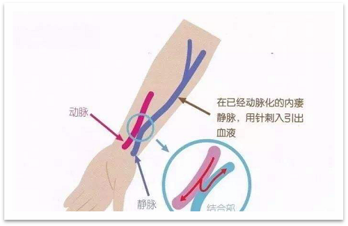 靜脈瘺最新資訊，掌握最前沿的健康信息